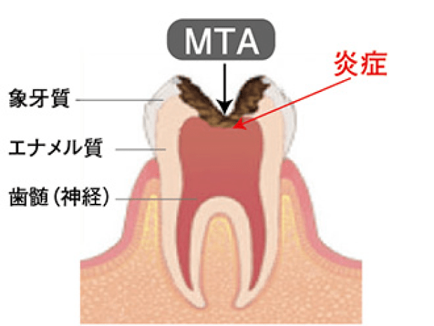 MTAセメントの説明図