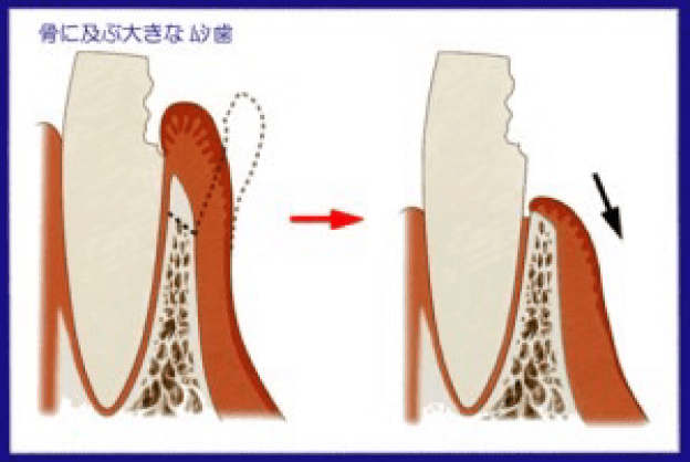 歯間延長術(レングスニング)の説明図