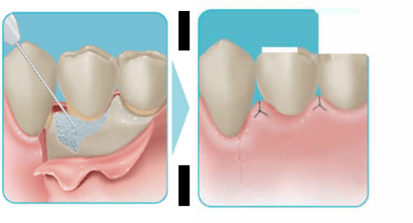 歯周組織再生療法のイメージ